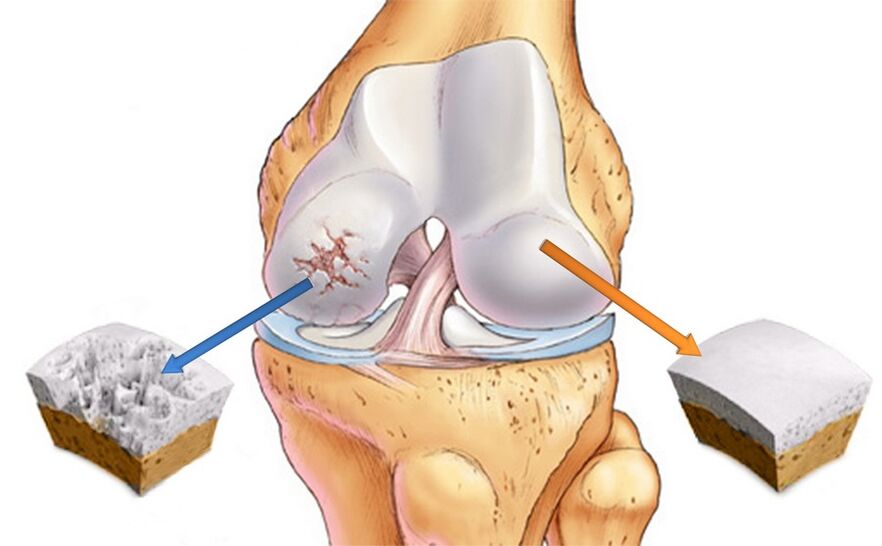Υγιής άρθρωση γόνατος (δεξιά) και επηρεασμένη από αρθροπάθεια (αριστερά)